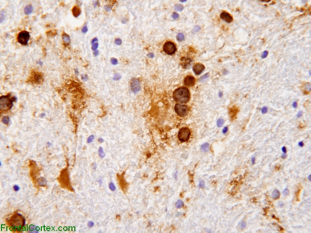 Progressive multifocal leukoencephalopathy, immunohistochemical staining for JC virus.